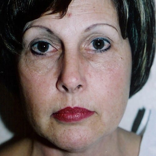 Laser Resurfacing 01 Before Photo