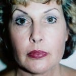 Laser Resurfacing 01 After Thumbnail Photo