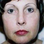 Laser Resurfacing 01 Before Thumbnail Photo