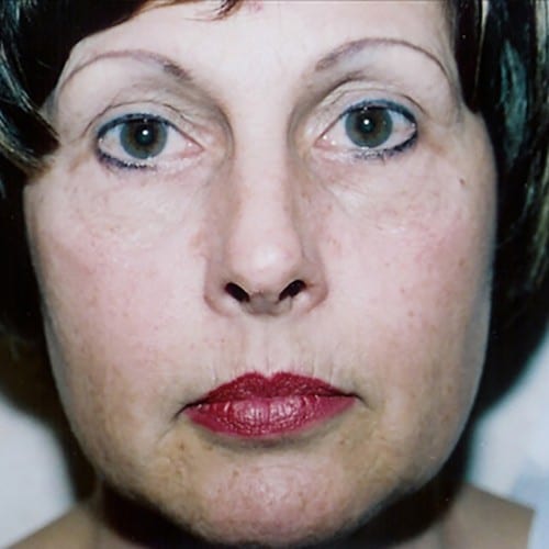 Laser Resurfacing 01 Before Photo