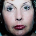 Laser Resurfacing 01 After Thumbnail Photo