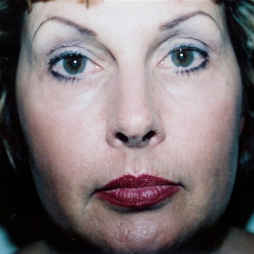 Laser Resurfacing 01 After Photo