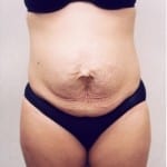 Mommy Makeover 01 Before Thumbnail Photo