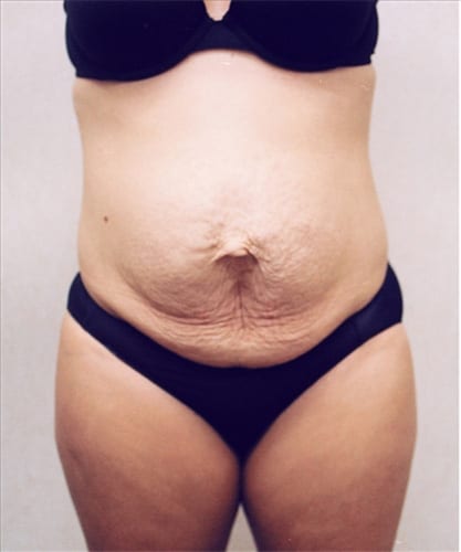 Mommy Makeover 01 Before Photo