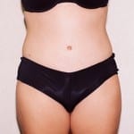 Mommy Makeover 01 After Thumbnail Photo