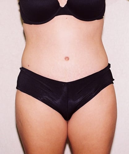 Mommy Makeover 01 After Photo