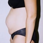 Mommy Makeover 01 Before Thumbnail Photo