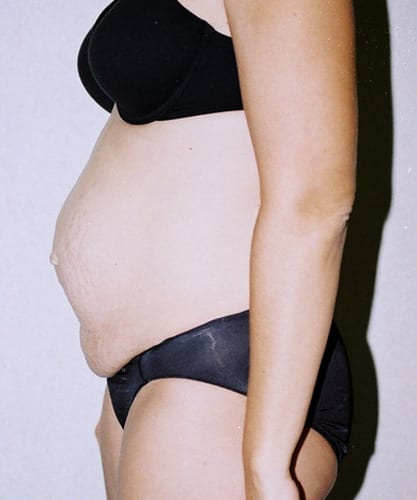 Mommy Makeover 01 Before Photo