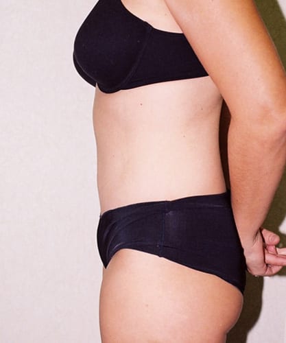 Mommy Makeover 01 After Photo