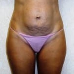 Mommy Makeover 02 Before Thumbnail Photo