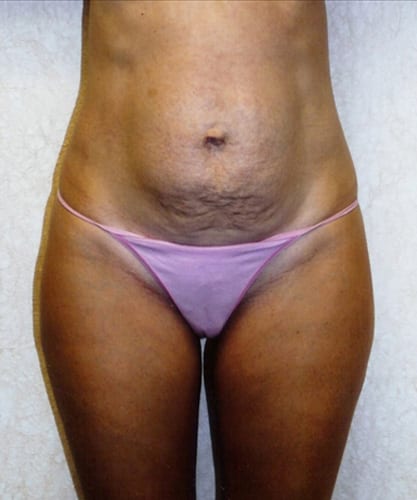 Mommy Makeover 02 Before Photo