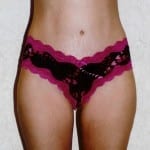 Mommy Makeover 02 After Thumbnail Photo