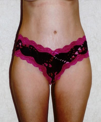 Mommy Makeover 02 After Photo