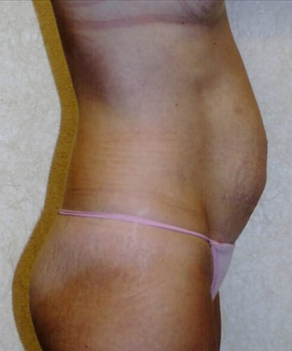 Mommy Makeover 02 Before Photo