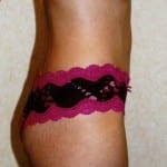 Mommy Makeover 02 After Thumbnail Photo