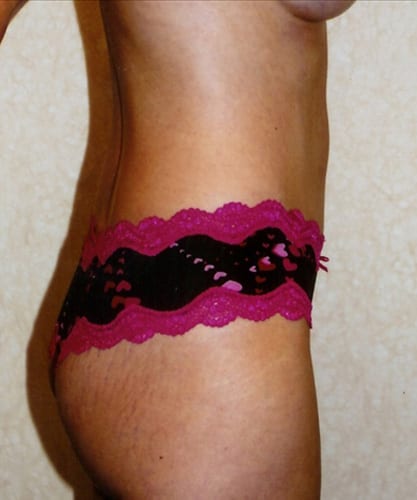 Mommy Makeover 02 After Photo