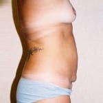 Mommy Makeover 03 Before Thumbnail Photo