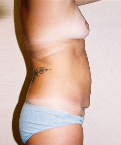 Mommy Makeover 03 Before Photo