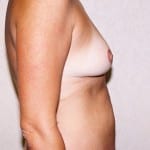 Mommy Makeover 03 Before Thumbnail Photo