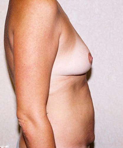 Mommy Makeover 03 Before Photo