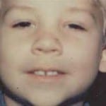 Otoplasty 01 Before Thumbnail Photo