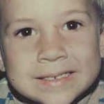 Otoplasty 01 After Thumbnail Photo