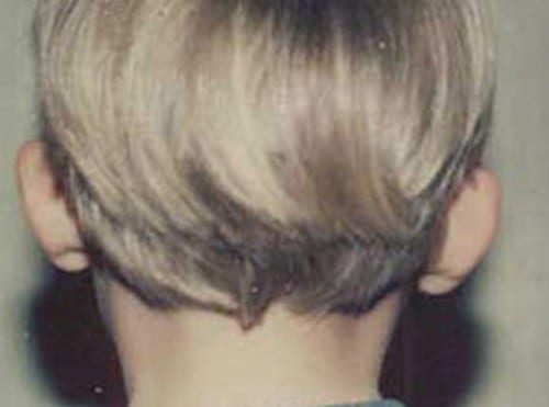 Otoplasty 01 Before Photo