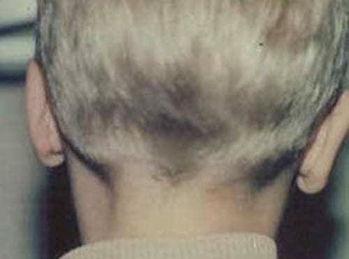 Otoplasty 01 After Photo