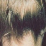 Otoplasty 02 Before Thumbnail Photo