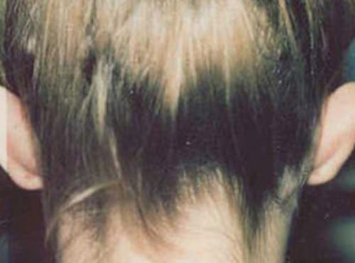 Otoplasty 02 Before Photo