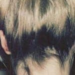 Otoplasty 02 After Thumbnail Photo