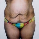 Abdominoplasty 02 Before Thumbnail Photo