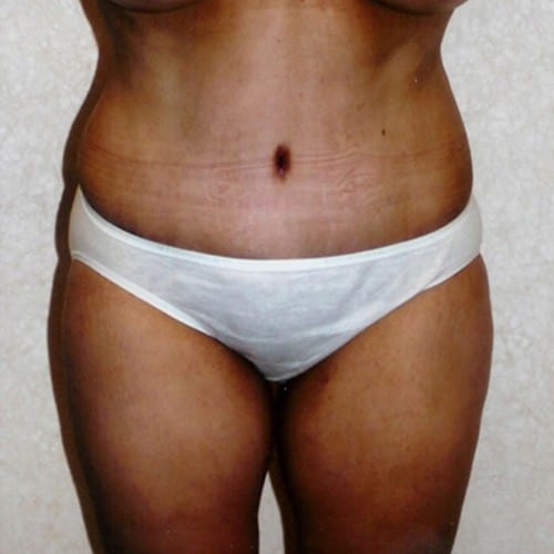 Abdominoplasty 02 After Photo