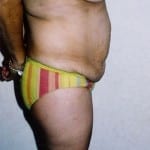 Abdominoplasty 02 Before Thumbnail Photo