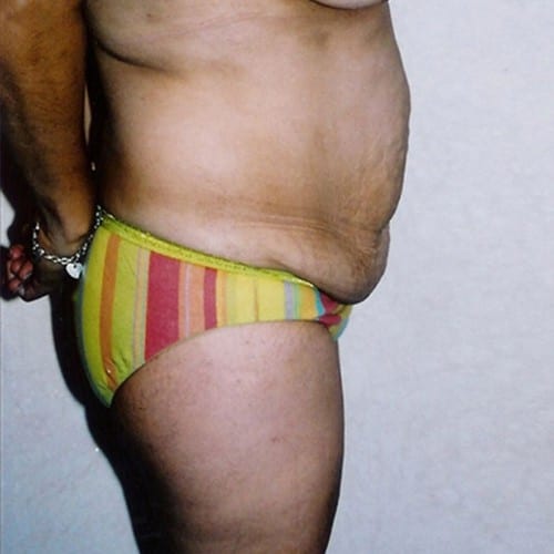 Abdominoplasty 02 Before Photo