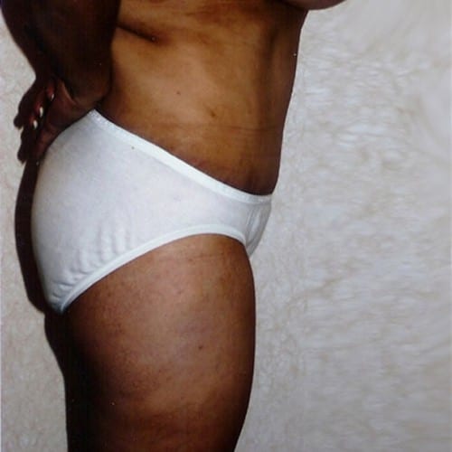Abdominoplasty 02 After Photo