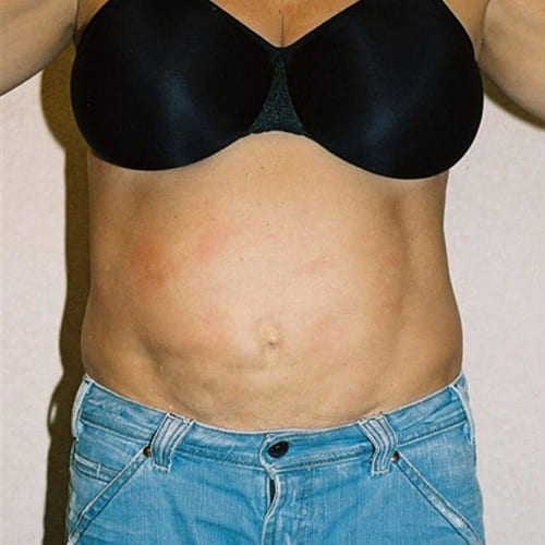 Abdominoplasty 05 Before Photo