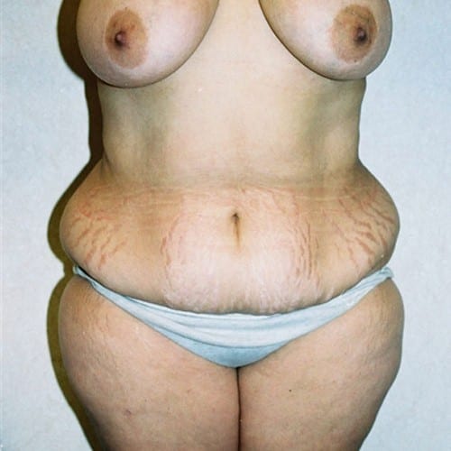 Abdominoplasty 06 Before Photo