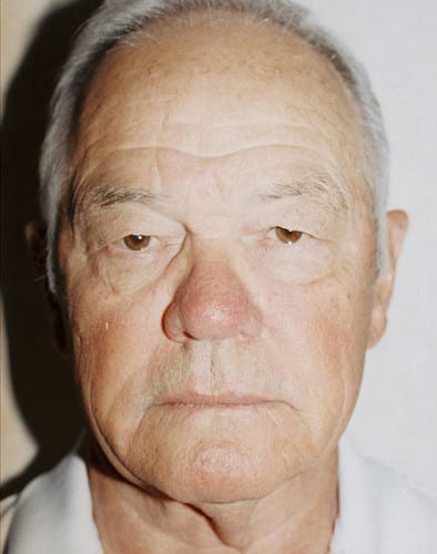 Male Cosmetic Surgery 02 Before Photo