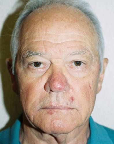 Male Cosmetic Surgery 02 After Photo