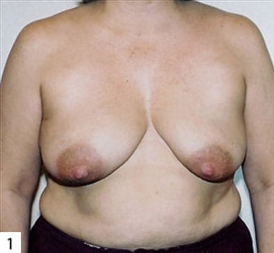 Breast Reconstruction 01 Before Photo