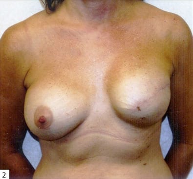 Breast Reconstruction 02 Before Photo