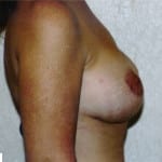 Breast Reconstruction 02 After Thumbnail Photo