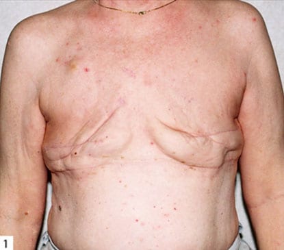 Breast Reconstruction 07 Before Photo