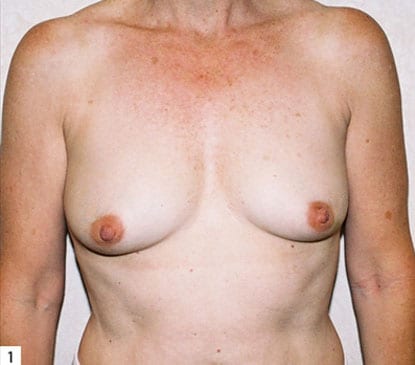 Breast Reconstruction 08 Before Photo