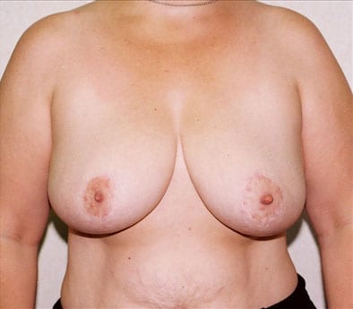 Breast Reduction 02 After Photo