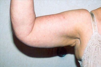 Liposuction 01 Before Photo