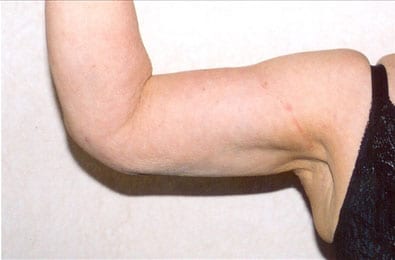 Liposuction 01 After Photo