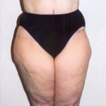 Liposuction 02 Before Thumbnail Photo