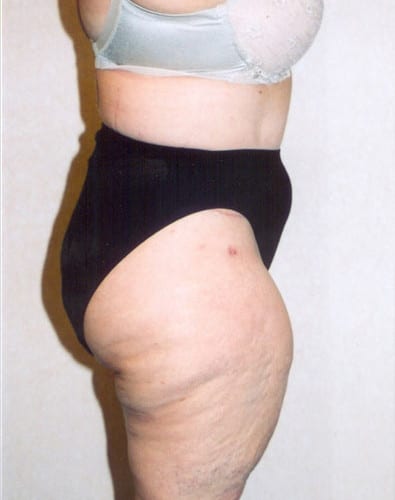 Liposuction 02 Before Photo